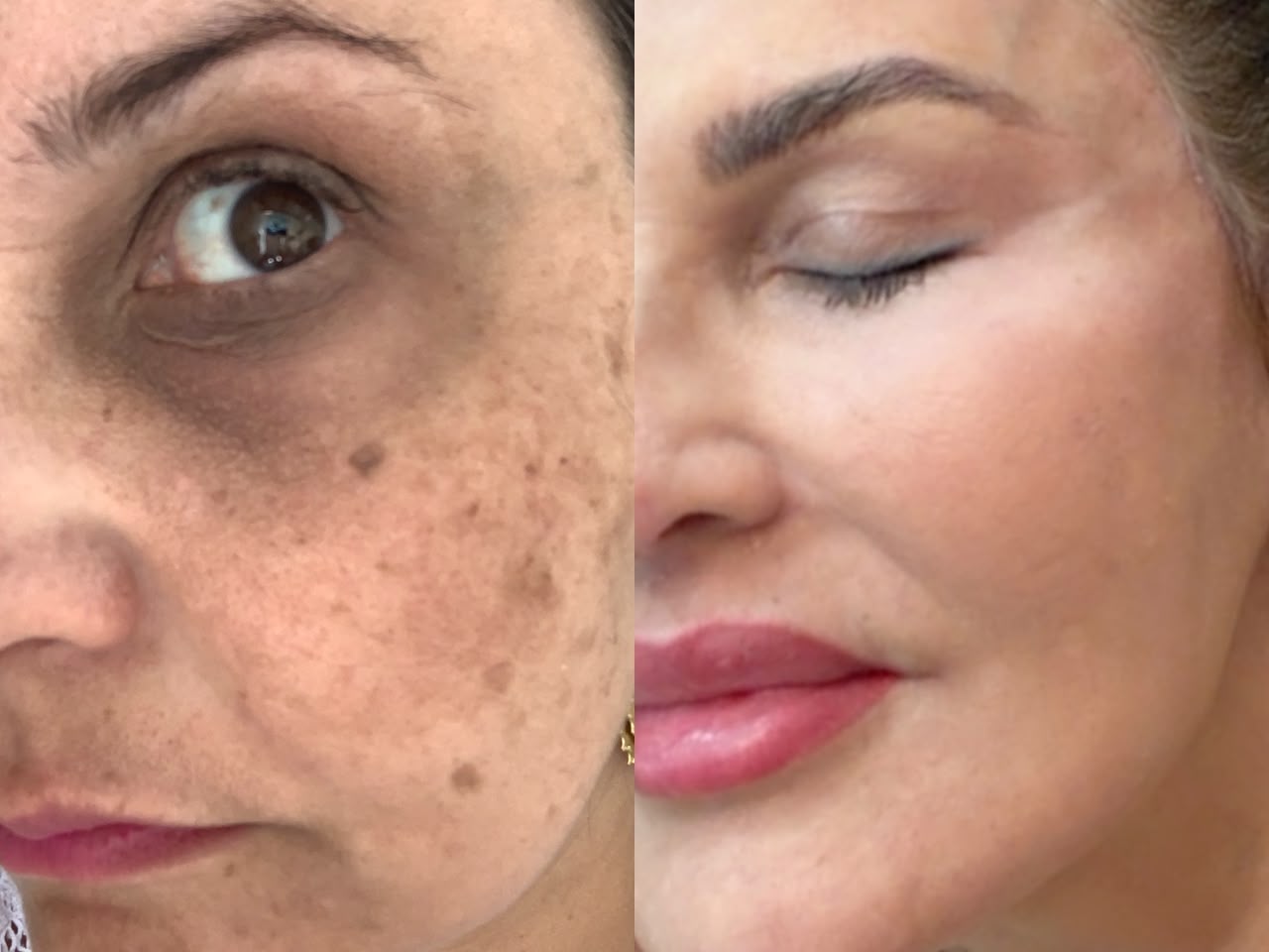 Laser CO2 Reversi - Rejuvenescimento Avançado